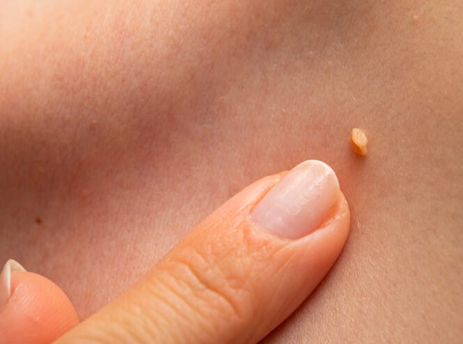 labioplasti.com.tr sitesi lazerle siğil tedavisi sayfası tema görseli
