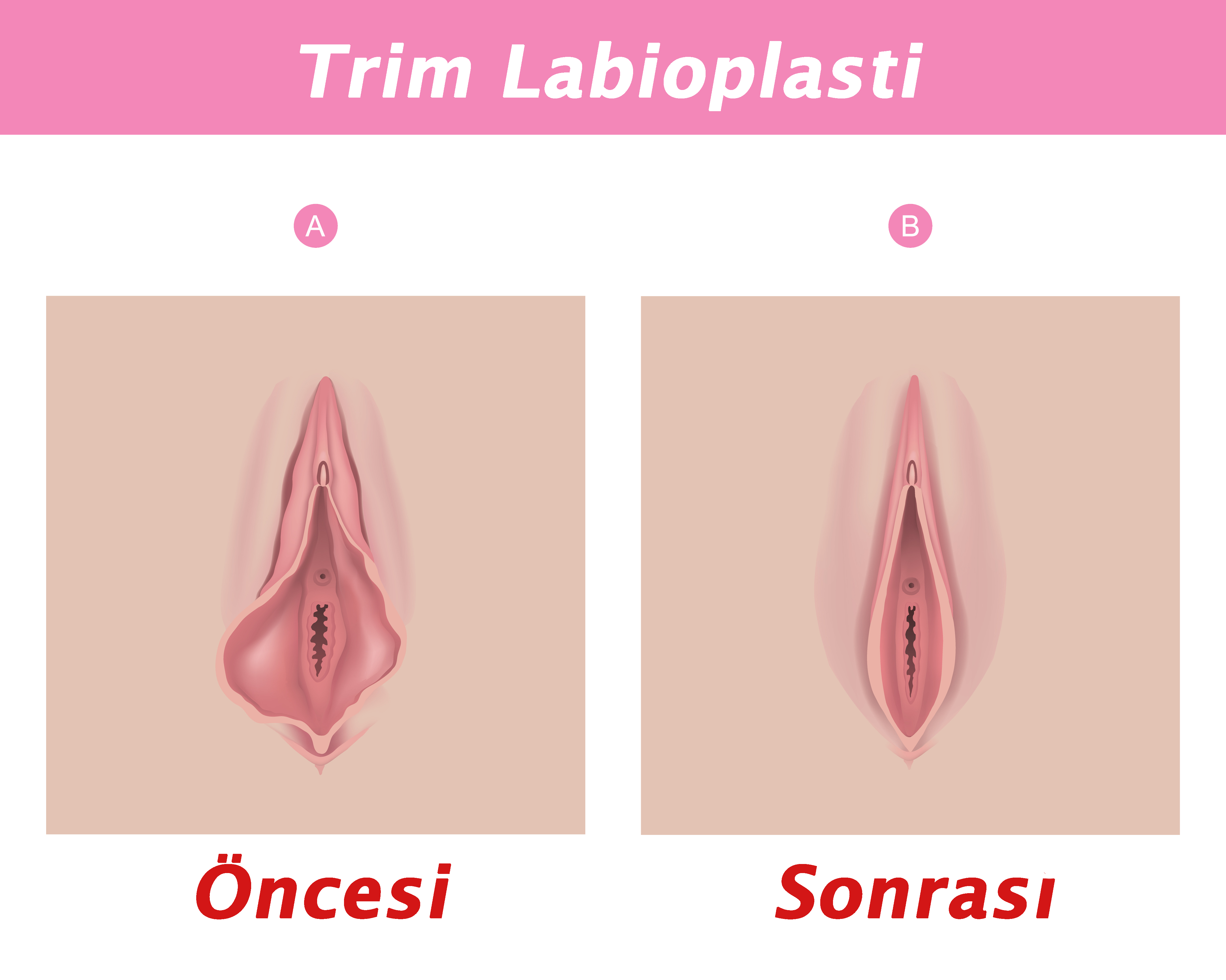 trim labioplasti öncesi sonrası çizimi