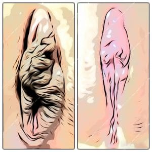 Hibrit labioplasti fotoğrafı 2